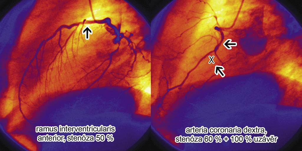 Černobílé šipky ukazují stenózy arteria coronaria dextra a ramus interventricularis anterior.