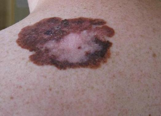 Typy maligního melanomu Melanom má dvě fáze růstu, radiální a vertikální. Během radiální fáze rostou maligní buňky v radiálním směru v epidermis.