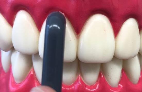 Indikujeme ho k dočišťování všech ploch zubů, obzvláště pak u pacientů s anomálií zubů, fixními ortodontickými aparáty, implantáty, můstky a také na dočišťování