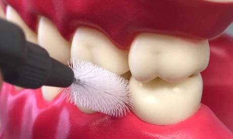 Ve srovnání s mezizubním kartáčkem je patrné nedostatečné vyčištění konkávních ploch všech laterálních zubů. Proto by měla být spíše druhou volbou při čištění mezizubních prostor.