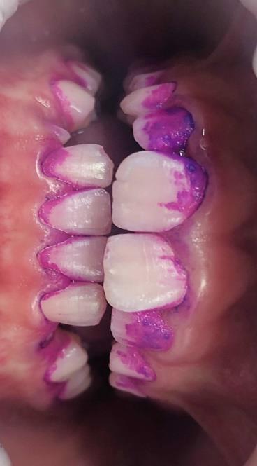 V tomto případě bylo zjištěno, ţe pacientka si zuby čistí bez dohledu rodičů. Pacientky stav ústní hygieny při první návštěvě byl nedostatečný.
