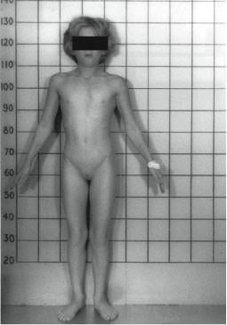 Aneuploidie pohlavních chromosomů u lidí Turnerův syndrom (45, X0) Ženy, nefunkční