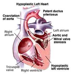 Příloha 3 Hypoplastické levé srdce