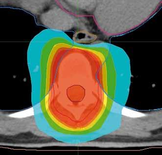 Obr. 2. Plán radioterapie na oblast hrudního obratle s možností nižší dávkové zátěže jícnu. Předepsaná dávka 30 Gy/10 frakcí. Ozařovací mód TomoHelical, šířka pole 2,5 cm.