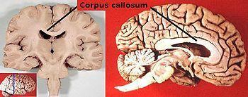 Svazek nervů, který spojuje mozkové hemisféry corpus callosum, jeden z nejpodstatnějších regionů pro jazykové zpracovávání Fissura longitudinalis odděluje lidský mozek na dvě cerebrální hemisféry,