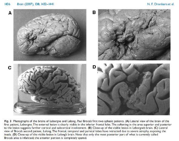 Broca dále zkoumal lateralizaci mozku ve své druhé významné studii (1865) zdůraznil, ţe pozorované případy afázie byly spojeny s levohemisferálními lézemi, coţ není náhodné.