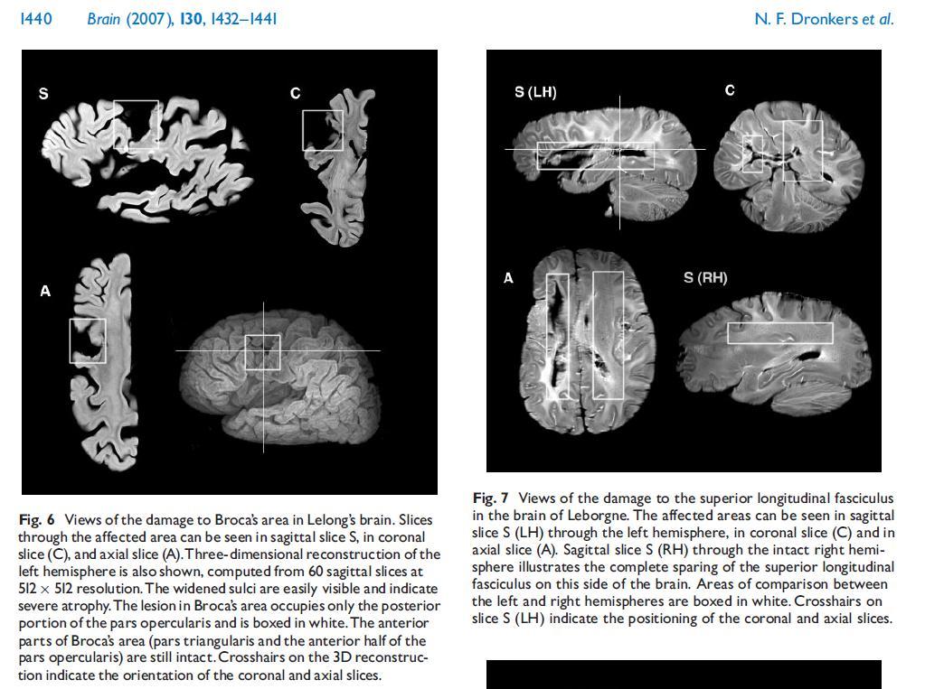 Brocovy hypotézy a s nimi také lokalizační přístupy dále podpořily sledování epileptiků, které prováděl německý neurolog Carl Wernicke (1874 9 ), protoţe léze působily specifické změny chování těchto