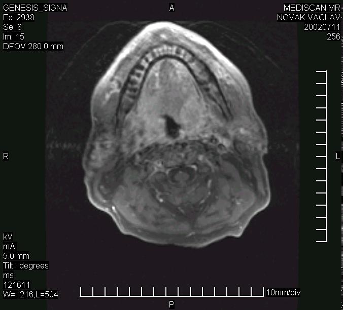 karcinomem nazofaryngu TNM při zobrazení