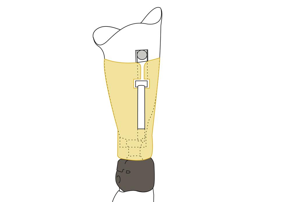 5 Tips and tricks Tip 1: liner with lanyard The bridging element must be slit proximally from the hole for the cord.