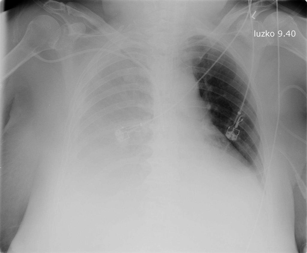 Hemothorax - Výpotek může být krvavý a není to hemotorax - Sanquin.