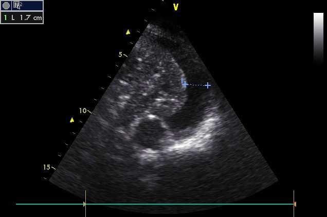 Výskyt a diagnostika pleurální tekutiny Prevalence 15-62% (medical ICU, Mattison LE: Chest 1997) Ultrasonografie