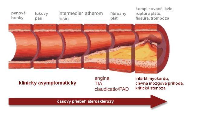 některé menší tepny a dochází k ischémii, což je nejčastější komplikace aterosklerózy.
