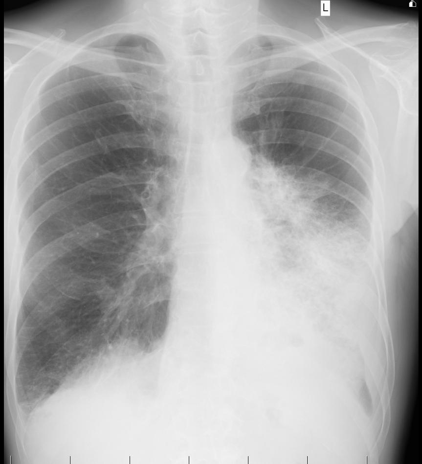 Laboratorně: BIO: CRP 169, ostatní analyty v normě KO+diff: WBC 13,3; Hb 131; PLT 323