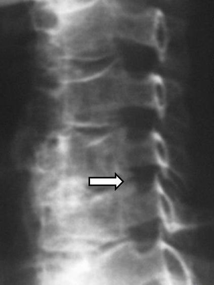 2.3.2 Osteofyty unkovertebrálních skloubení Horní plochu obratlových těl 3. krčního aţ 1. hrudního obratle ohraničují po obou stranách tzv. uncinátní výběţky (processus uncinati).