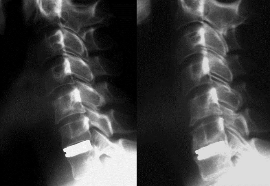 Operačně byly odstraněny meziobratlové ploténky C4/5 a C5/6 a anatomická situace rekonstruována za pomocí meziobratlově vloţených štěpů a dlahy.