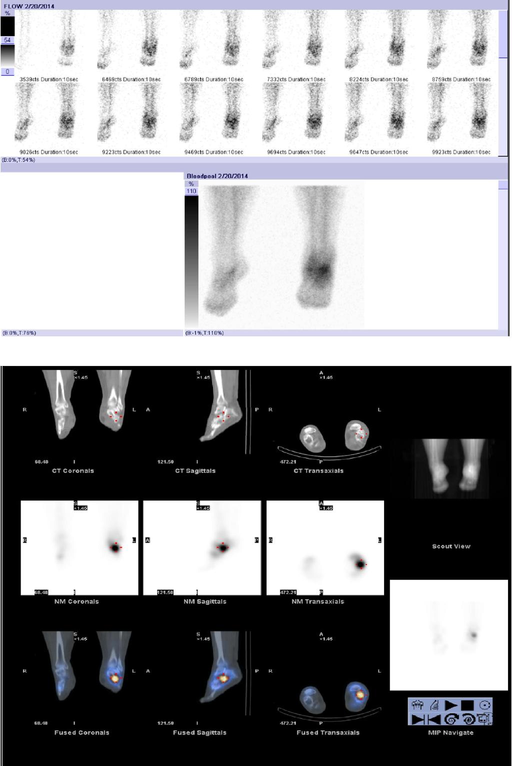 Příloha 7 - Třífázová scintigrafie skeletu -