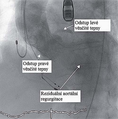 preprocedurální zhodnocení anatomických a funkčních parametrů.