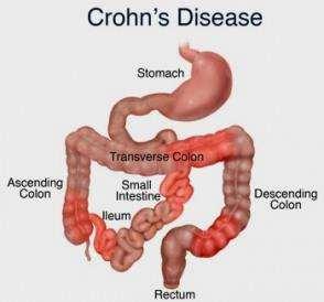 Příklad I Crohnova nemoc 1 dg.