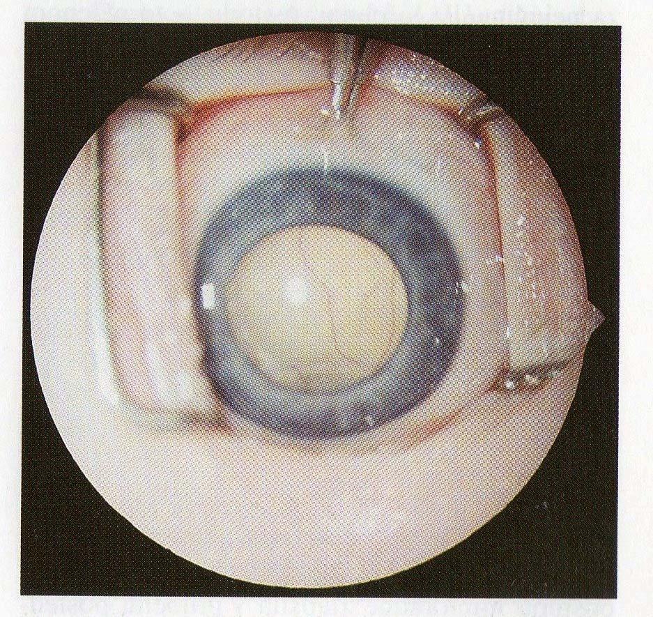 může projevit strabismem 1. Proto každé malé šilhající dítě je nutno vyšetřit v mydriáze. Tyto počínající nálezy jsou označovány jako oftalmoskopické stádium retinoblastomu.