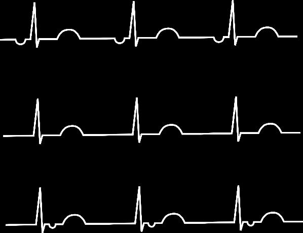 3. RYTMUS určen centrem automacie primární pacemaker - SA uzel náhradní centra automacie - AV