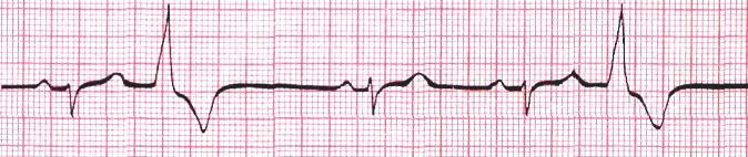 QRS, nemá vlnu P Interpolované ES: bez kompenzační pauzy