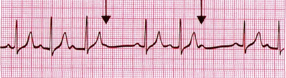 I - PQ nad 0,2 s - Mobitz 1 (Wenckebachovy