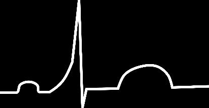 krátký PR (PQ) interval, vlna δ Syndrom