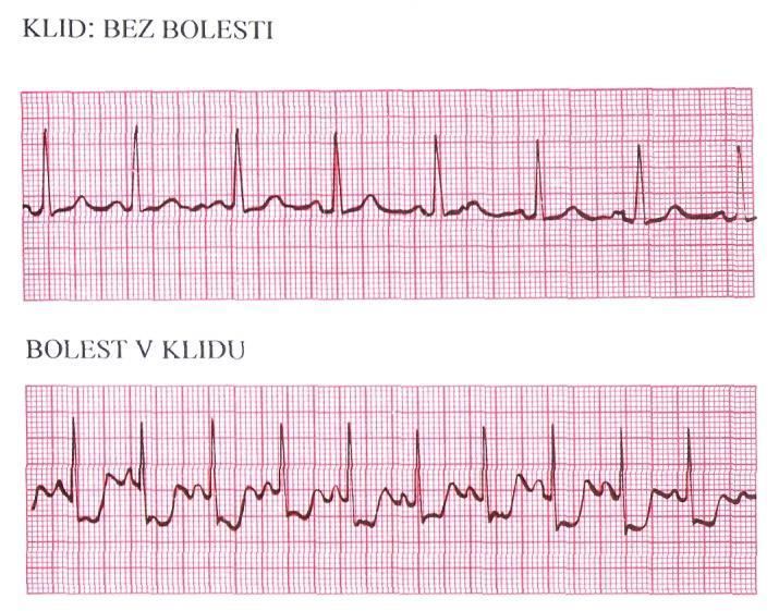 deprese při zátěži Angina pectoris