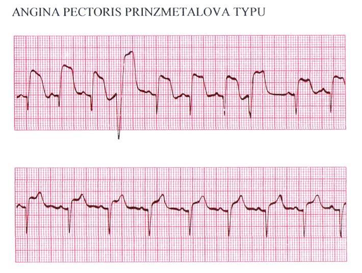 pectoris elevace v klidu Záchvat, bolest