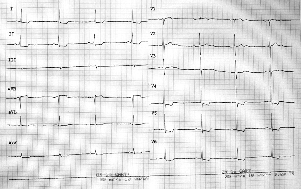 Angina pectoris ischemické