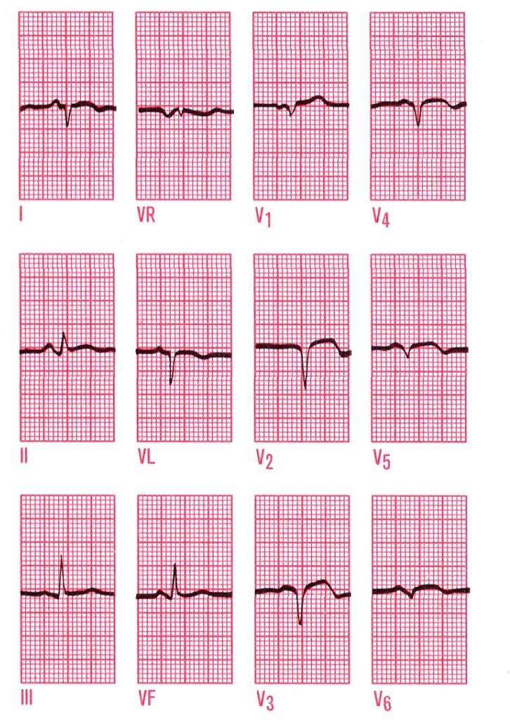 STEMI, Q infarkt myokardu Vývoj