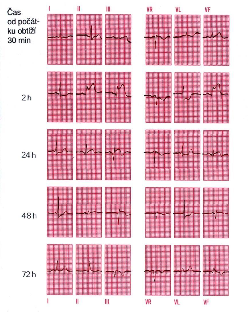 Stav po infarktu přední stěny s