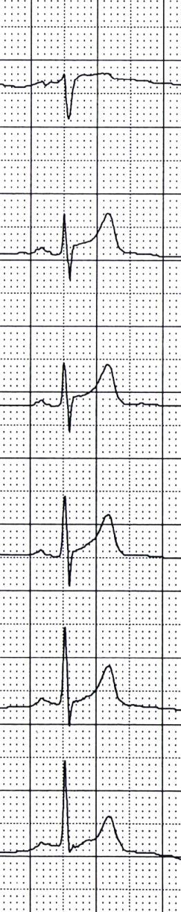 SYNDROM PŘEDČASNÉ REPOLARIZACE V1 V2 V3 V4 V5 Šipky označují tzv. bod J: místo, kde QRS komplex přechází do segmentu ST.