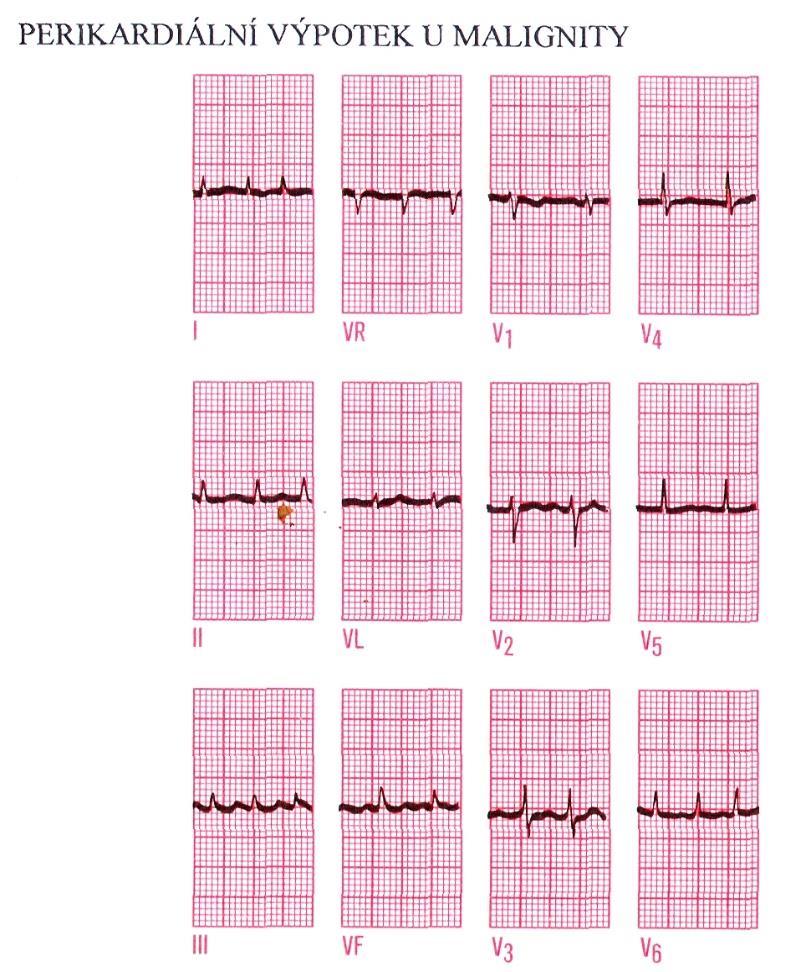 NÍZKÁ VOLTÁŽ - obezita - perikardiální, pleurální výpotek perikarditis, malignity,