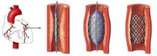balon-expandibilní katétr pletivový koronární stent z ušlechtilé