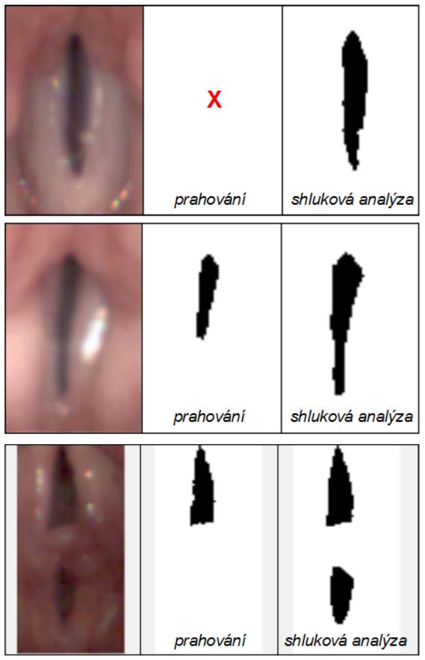 Vlastní metoda pro detekci hlasivek Segmentace shlukovou analýzou 4.2.