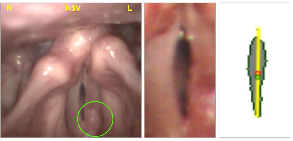 Parametry hlasivkové štěrbiny Těžiště hlasivkové štěrbiny Nesymetrická hlasivka - karcinom Popis: Nesymetrická hlasivka, omezení pohybu hlasivky vlevo (karcinom) (obr. 6.16). Muž 82 let.