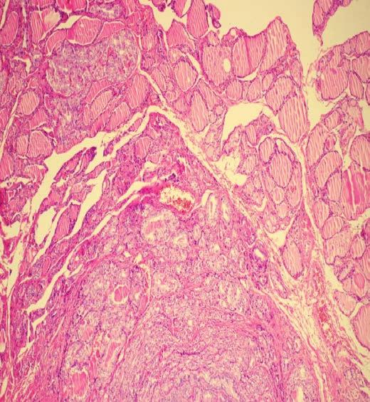 ductus thyreoglossus, středové branchiální cysty, epidermální cysty, fibrózních tumorů.
