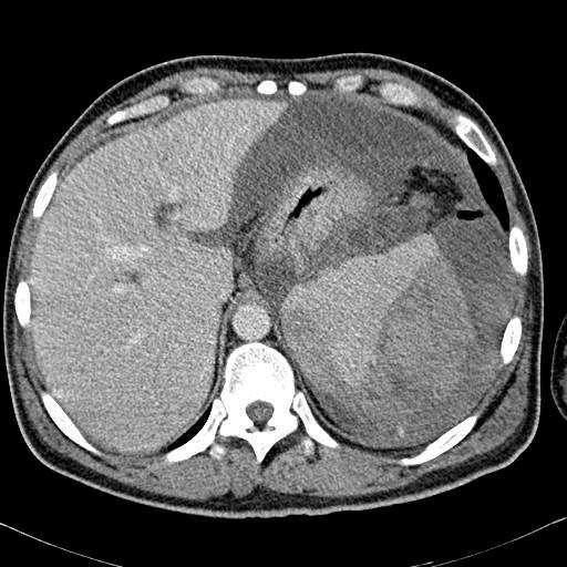 CT nález: pseudocysta pankreatu v progresi velikosti pneumoperitoneum