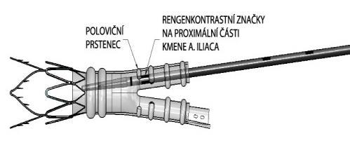 7 Za kontinuální skiaskpické kontroly vložte zaváděcí systém kmene a. iliaca do cévního systému, aby se rentgenkontrastní značky kmene a.