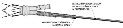 3 Pokud chcete použít kmen a. iliaca jako prodloužení, přečtěte si následující tabulku. Dle distálního průměru kmene a.