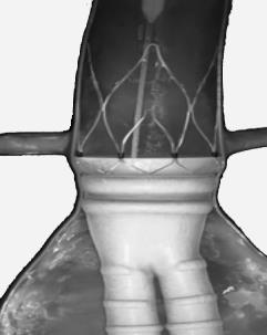 1.1. Zaváděcí systém Obrázek 2. Stent-graft aortálního těla v aortě Aortální tělo, kmeny a. iliaca a prodloužení a.