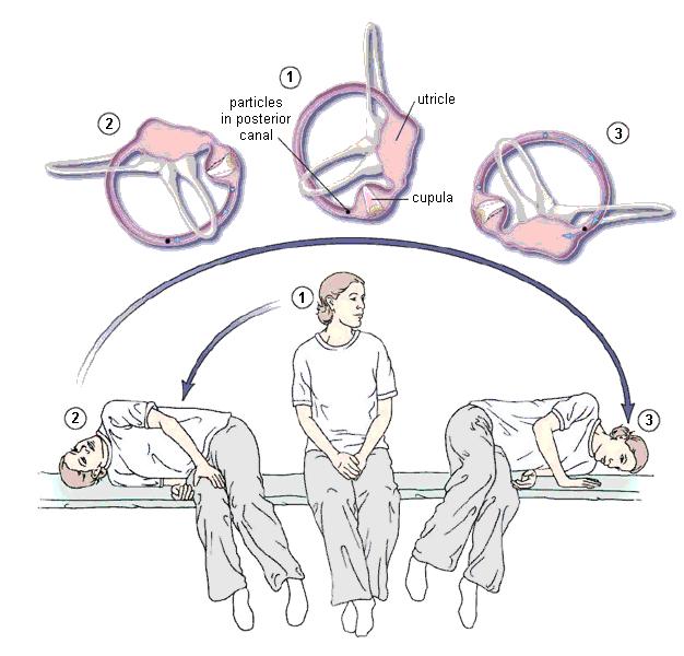 Benigní paroxysmální polohové vertigo BPPV is characterized by brief episodes of mild to intense dizziness.