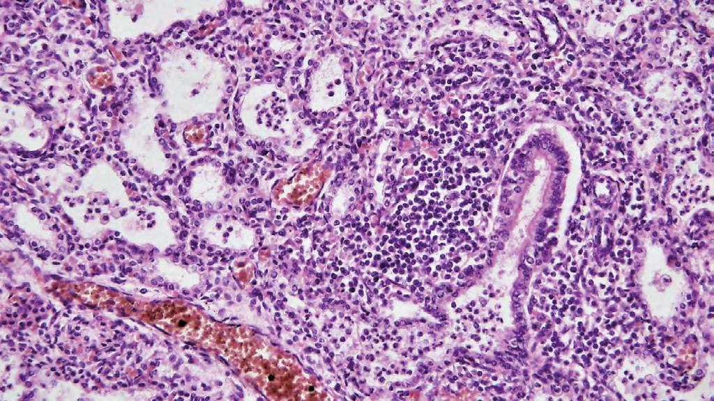 KLINICKÁ HODNOTA DIAGNOSTIKY Novorozeneckou sepsí se označuje bakteriální sepse propukající v prvním měsíci po porodu.