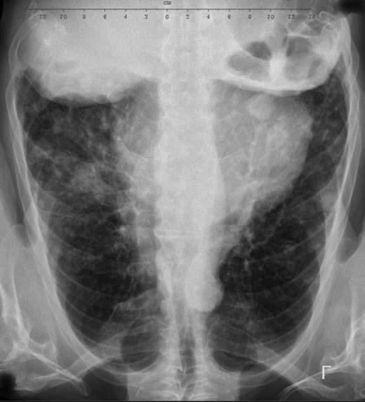 cient podstoupil bronchoskopii. Z transbronchiální plicní biopsie byl potvrzen plicní adenokarcinom, EGFR, ALK a ROS1 negativní, PD-L1 exprese 90%. Dne 19.
