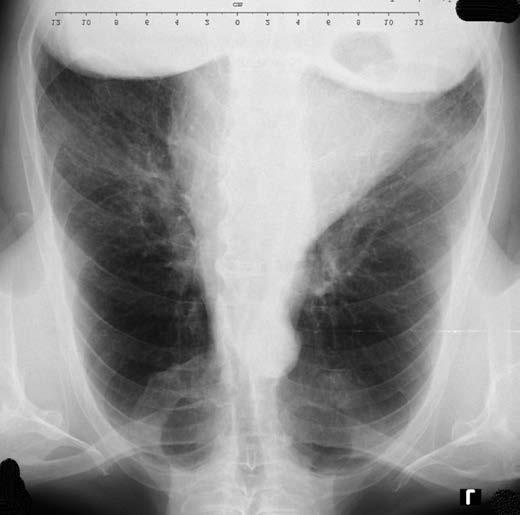 1: Skiagram hrudníku v době diagnózy, před léčbou, květen 2019 Od 25. června 2019 jsme zahájili léčbu pembrolizumabem v dávce 200 mg intravenózně každé 3 týdny.