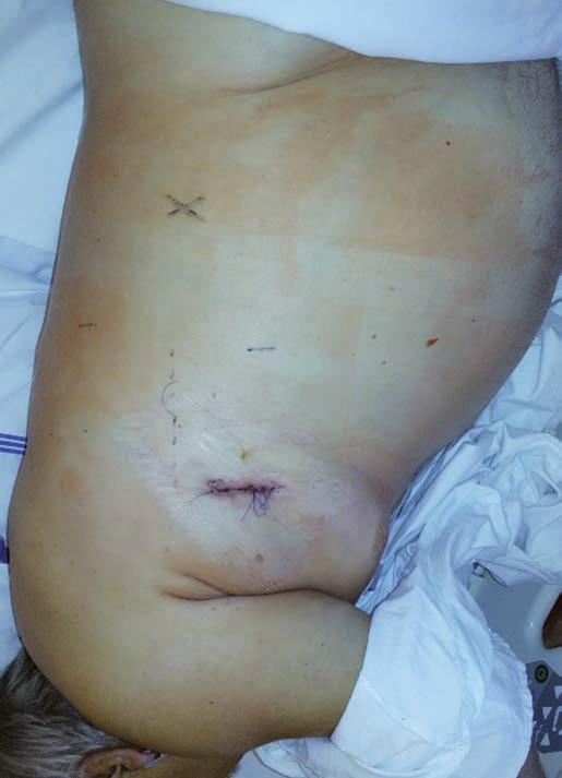 srdce naléhá kraniálně odstupem arteria pulmonalis, levou síní s odstupujícím ouškem levé síně, těsně nad odstupem plicních žil a kaudálněji pak stěnou levé komory.