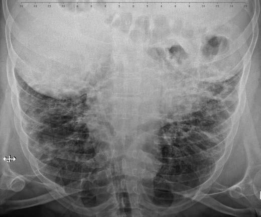 Abstrakta Abstrakta jsou řazena dle pořadí v programu 1 Co je covid-19 a jak na něj Martina Vašáková, Tomáš Slisz Pneumologická klinika, 1.