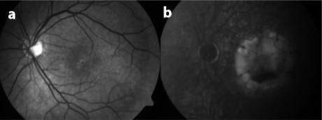 2.6.1 Fluorescenční angiografie Dalším z vyšetření je fluorescenční angiografie (FAG), která je založena na pricnipu fluorescence a poskytuje informace o stavu hematoretinální bariéry.