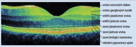 2.6.2 Optická koherenční tomografie Jedním z vyšetření, které se používá k hodnocení onemocnění v průběhu léčení je optická koherenční tomografie (OCT), která zobrazuje struktury makuly v příčném